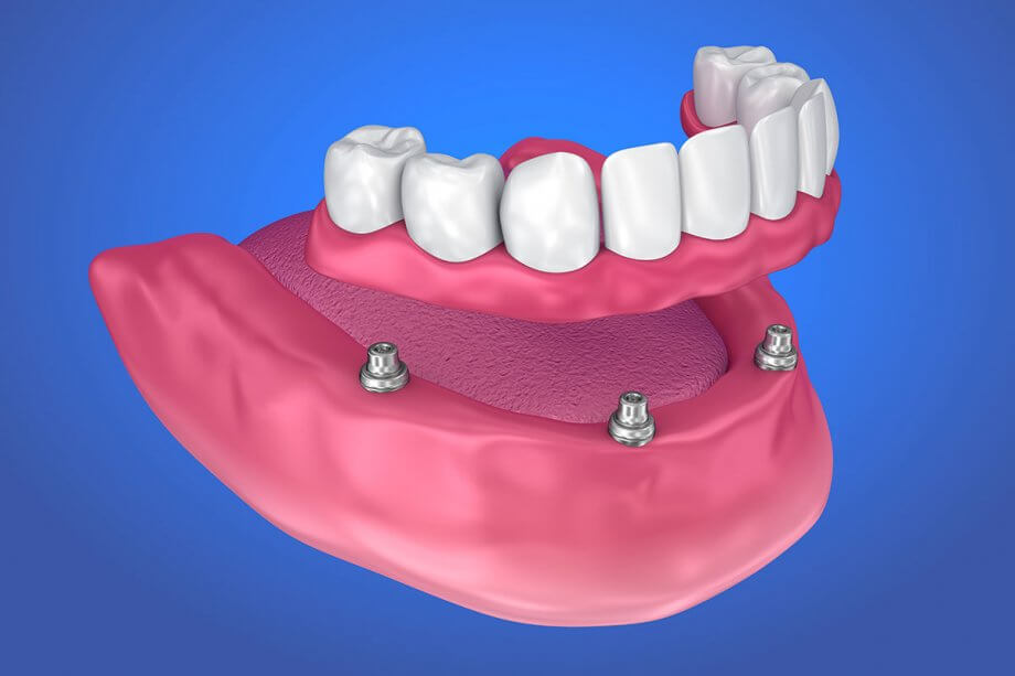 Dentures at Keluarga Dental Smile, Sentul Kuala Lumpur