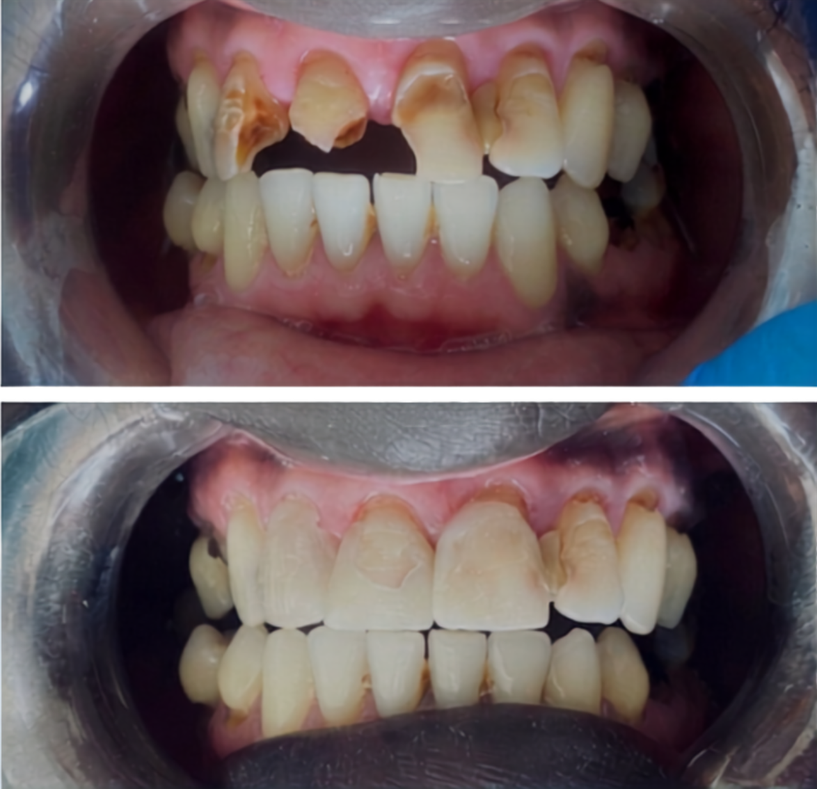 Before and after full mouth dental rehabilitation